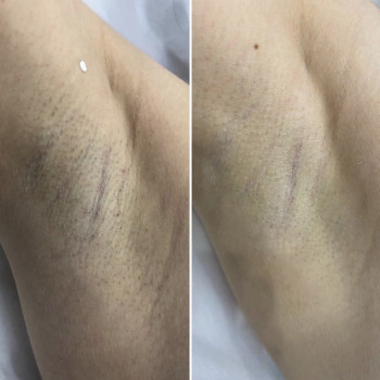 до и после лазерной эпиляции 2 процедуры