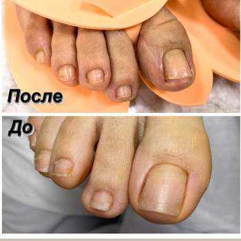 Лечение вросшего ногтя