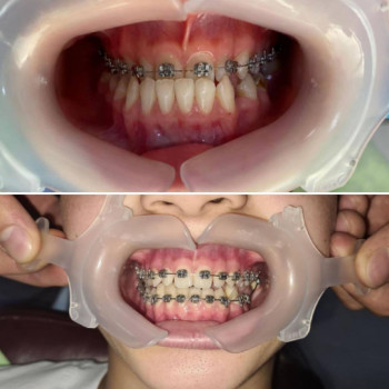 Отбеливание зубов Beyond