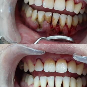 Пластина для выравнивания зубов