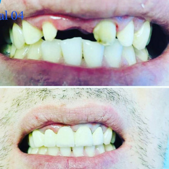 Удаление зуба ультразвуком