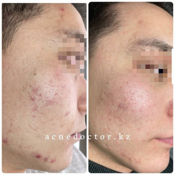 Acne Doctor, Almaty Фото - 5