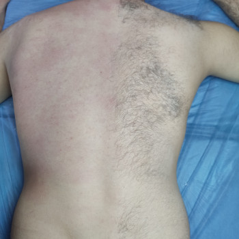 Шугаринг спины / Cukrování zpět