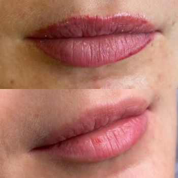 Лазерное удаление ДО/ПОСЛЕ