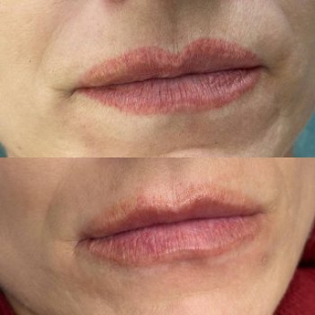 Лазерное удаление ДО/ПОСЛЕ