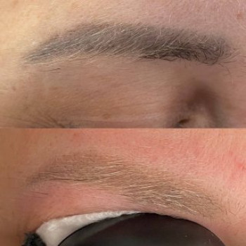 Лазерное удаление ДО/ПОСЛЕ