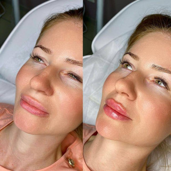 Anti-wrinkle facial massage
