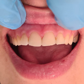 Удаление корня зуба