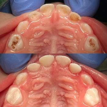 Имплантация зубов