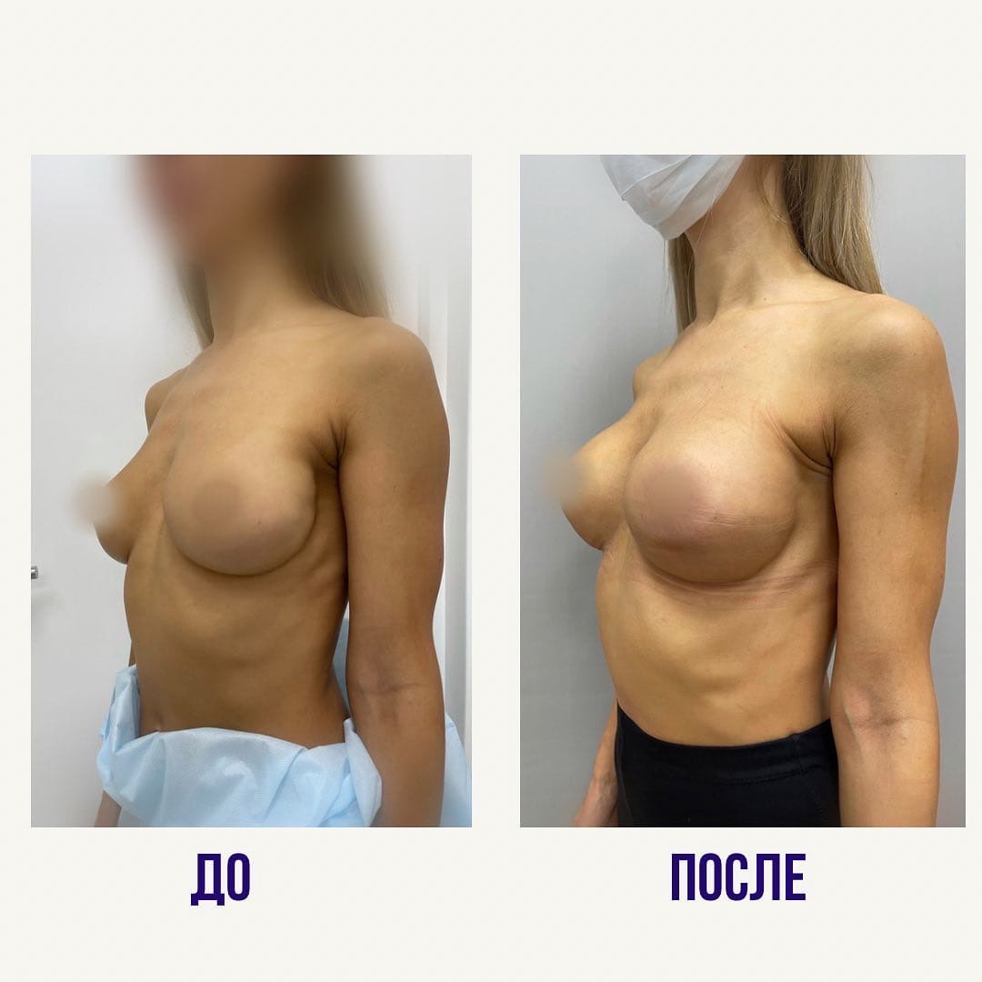 упражнение для уменьшения груди у женщин фото 57