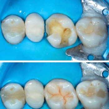 Профилактика заболеваний зубов