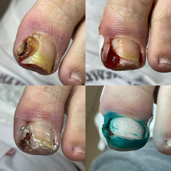 Протезирование ногтей