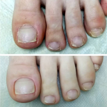 Лечение грибка ногтей