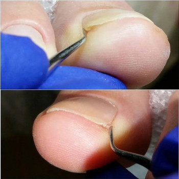 Лечение грибка ногтей