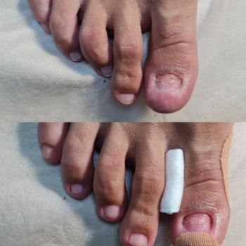 Покрытие ногтей на ногах