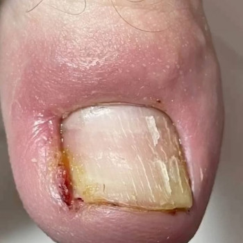 Лечение вросшего ногтя