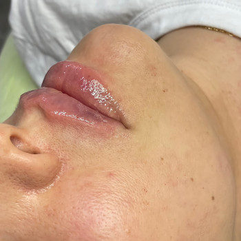 Увеличение губ 