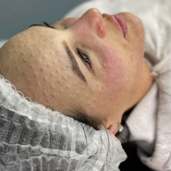 Биоревитализация