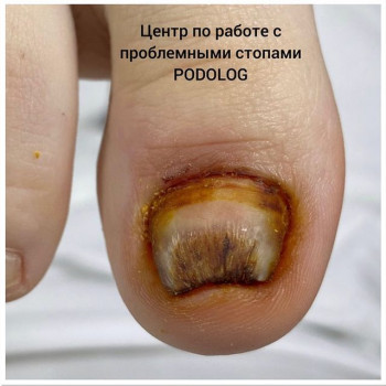 Протезирование ногтей