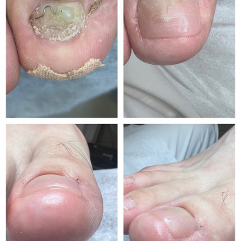 Восстановление ногтей после неудачного хирургического вмешат