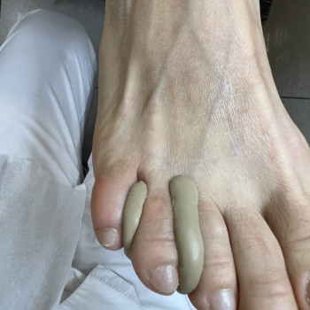 Изготовление межпальцевых ортозов