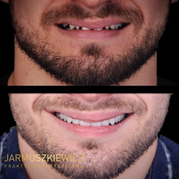 Удаление зубов под наркозом