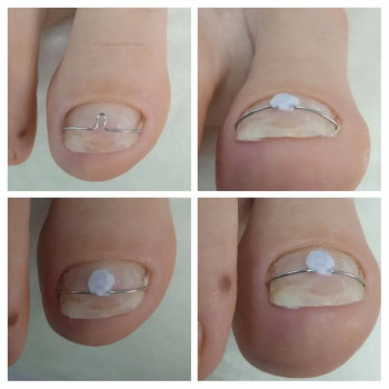 Скоба Фрейзера

