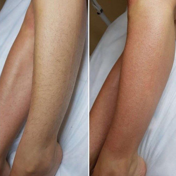 Medical laser, Yekaterinburg Фото - 5