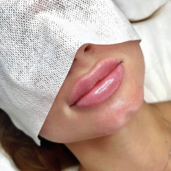 Контурная пластика губ 
                    Cosmetologist Lidiia Komkova Warsaw