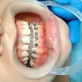 Чистка зубов ультразвуком