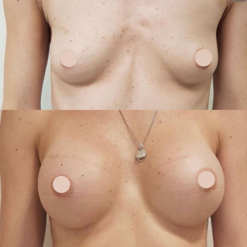 Липофилинг груди