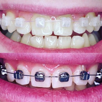 Удаление зубов