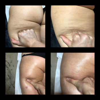 Масаж антицелюлітний 
                    Массажист Olesja Dovhanych Кладно