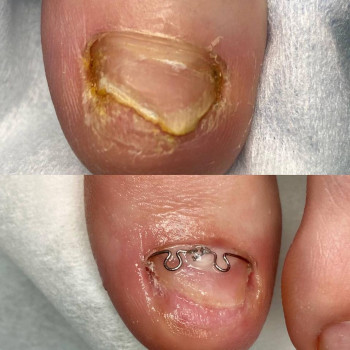 Установка титановой нити для коррекции роста ногтя
                    Педикюр и подология Центр Аппаратного Педикюра Volgograd