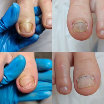 Установка титановой нити для коррекции роста ногтя
                    Педикюр и подология Центр Аппаратного Педикюра Volgograd
