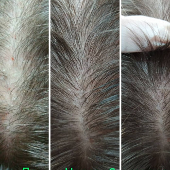 Мезотерапия препаратом Hair Zone Dermika. Результат за 2 мес