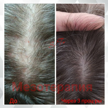 Мезотерапия препаратом Hair Zone Dermika. Результат за 2 мес