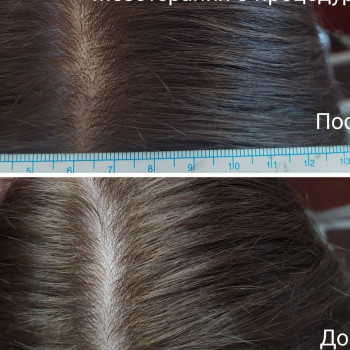 Мезотерапия волос препаратом Dermaheal HL,  результат за 1 м