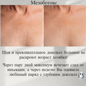 Лечение гипергидроза (Botox)