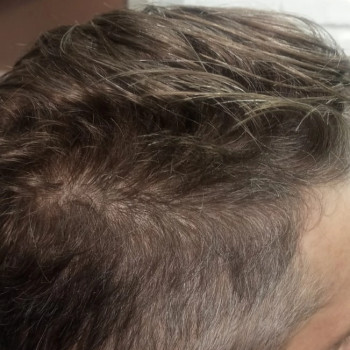 Биксипластия волос