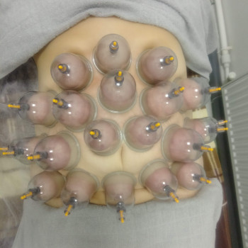 Вакуумные банки активизируют  защитные свойства организма, п