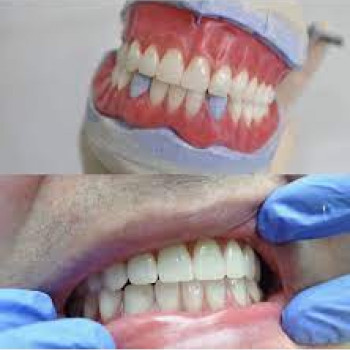 Отбеливание зубов Beyond