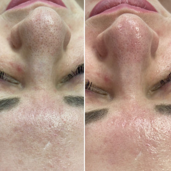 Anti-wrinkle facial massage