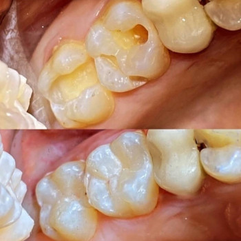 Ортопантомограмма зубов