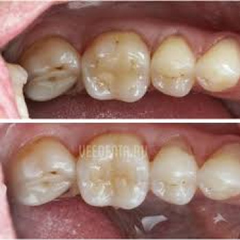 Профилактика заболеваний зубов