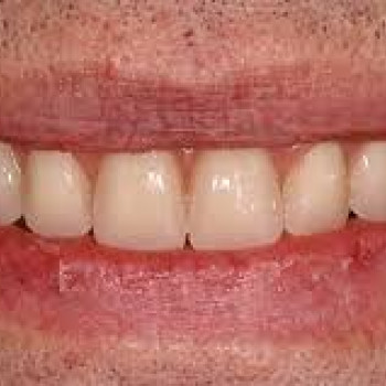 Отбеливание зубов Opalescence