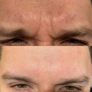Ultrasonic face cleaning