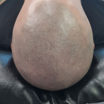 Трихопигментация 
                    Мастер перманентного макияжа, трихопигментации Алена Бодрова Saint Petersburg