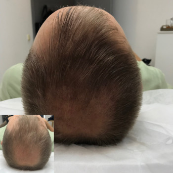 Трихопигментация 
                    Мастер перманентного макияжа, трихопигментации Алена Бодрова Saint Petersburg