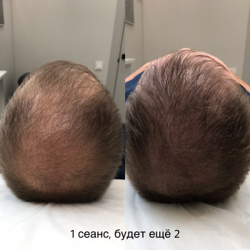 Трихопигментация 
                    Мастер перманентного макияжа, трихопигментации Алена Бодрова Saint Petersburg